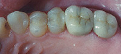 Today's Dentistry - Natural looking dental crowns